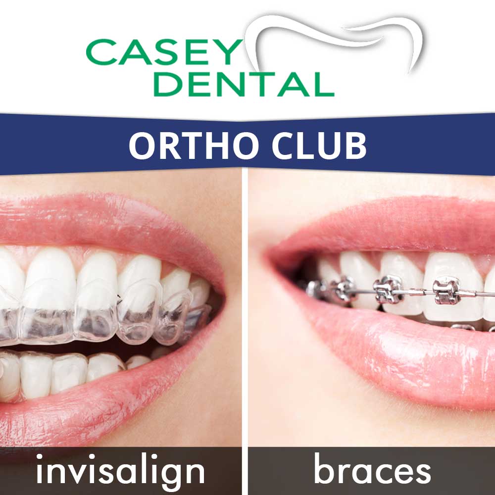 Membership Plans Casey Dental Ortho Club